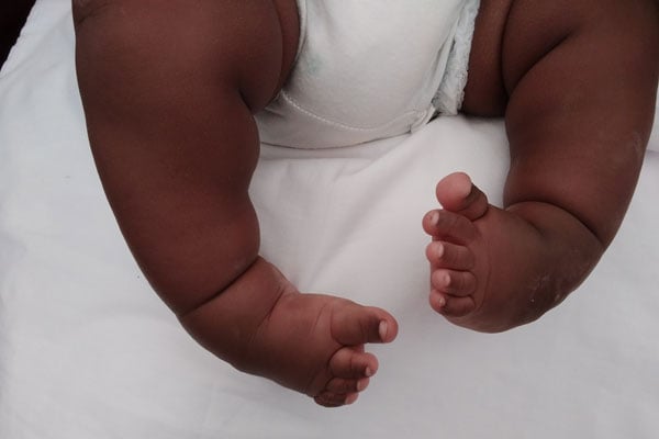 Clubfoot Why It Happens And How Doctors Treat It Daily Monitor