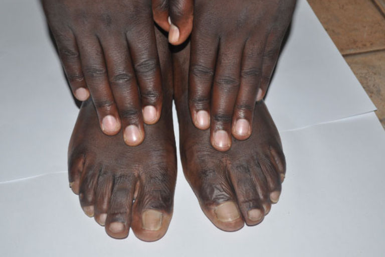 why-are-my-toes-turning-dark-daily-monitor