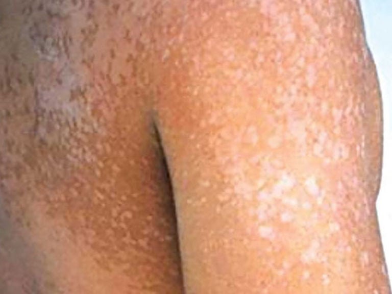 White Spots On Body Disease Name