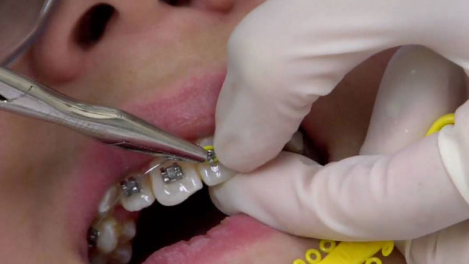 Teeth Braces and Treatment in Kampala - Dental Clinic in Kampala