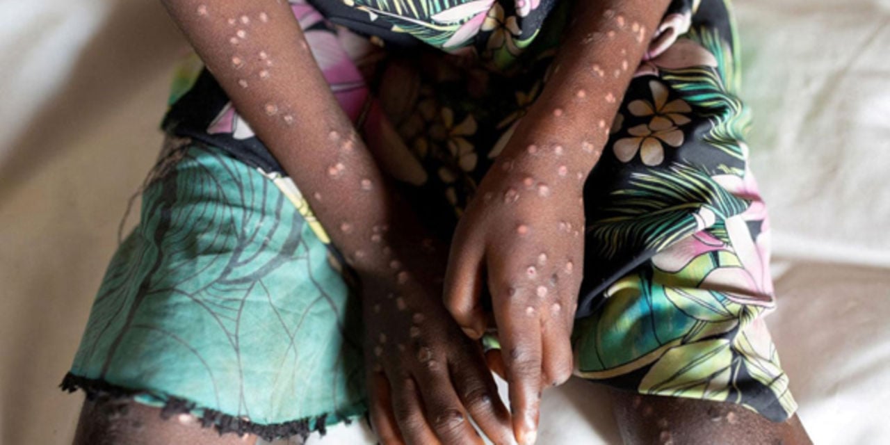 Africa CDC Likely To Declare Mpox Public Health Emergency Next Week ...